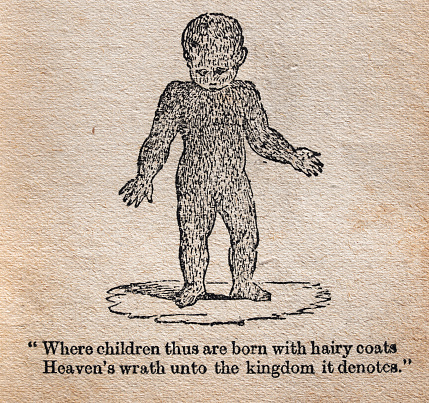 Vintage illustration Child born with Hypertrichosis, an abnormal amount of hair growth over the body, from Aristotle's Masterpiece