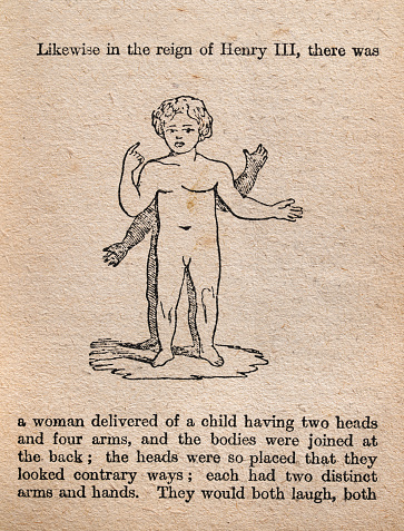 Vintage illustration Conjoined twins, joined at the back, History of medicine, from Aristotle's Masterpiece