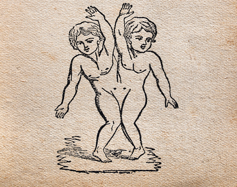 Vintage illustration Conjoined twins, joined at the side, History of medicine, from Aristotle's Masterpiece