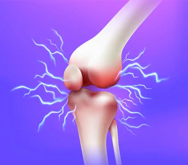 Vector illustration of Knee joint pain and tendon problems