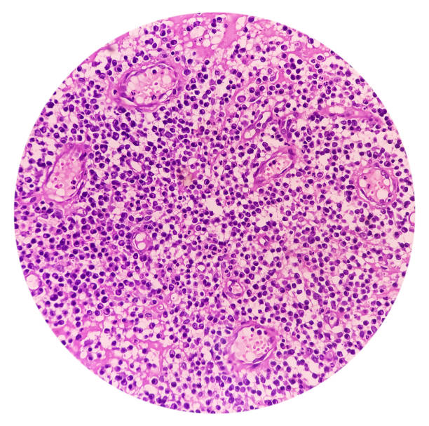istock Ear (biopsy): Microphotograph of Granulation tissues, show dense infiltration of polymorphs, lymphocytes, histiocytes and foreign body giant cell. proliferation of fibroblasts, keratinocytes. 1743870961