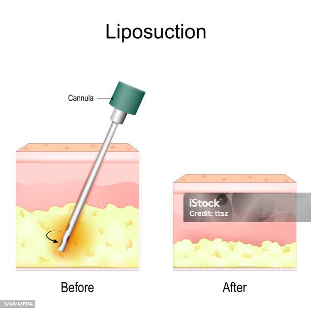 Liposuction Process Liposuction Procedure Stock Illustration - Download Image Now - Cannula ...