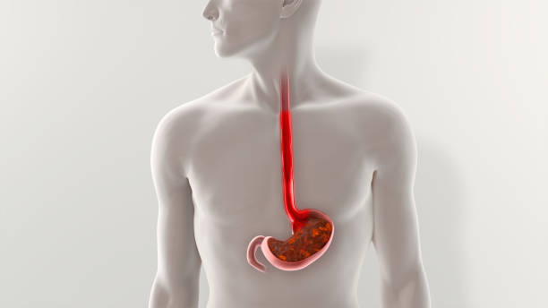 istock Acid Reflux GERD Disease Illustration 1745127022