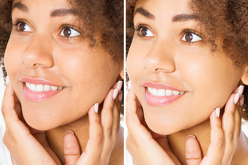 Before after close up african american woman face with acne and problem skin. Beauty skin care treatment. Before-after Facial problems. Dermatology cosmetology changing procedures. Afro beautiful girl