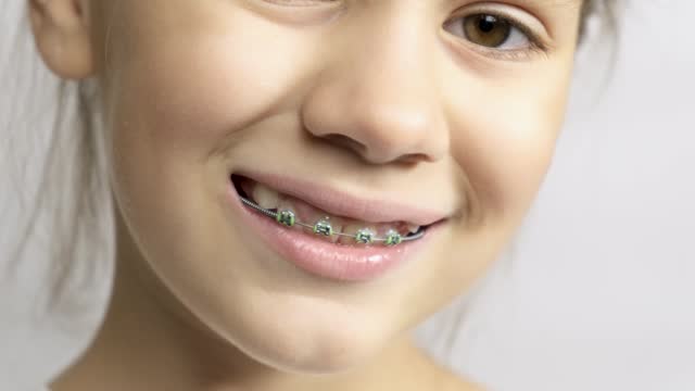 Smile of a little girl with braces installed. Close-up.