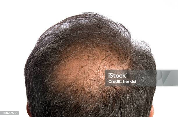 To Become Bald Stock Photo - Download Image Now - Loss, Men, Only Men