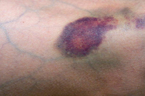 Bruise Bruised leg showing veins. Main focus is on bruise at center of image. bruise stock pictures, royalty-free photos & images