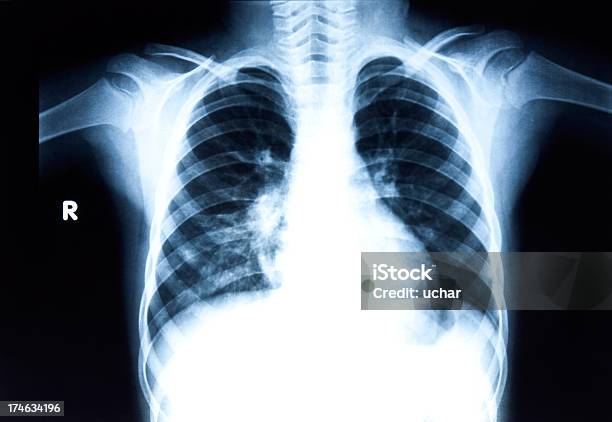 Radiografia Do Tórax - Fotografias de stock e mais imagens de Cavidade Toráxica - Cavidade Toráxica, Coluna vertebral humana, Costela