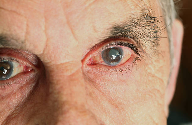 Sick eyes  glaucoma photos stock pictures, royalty-free photos & images