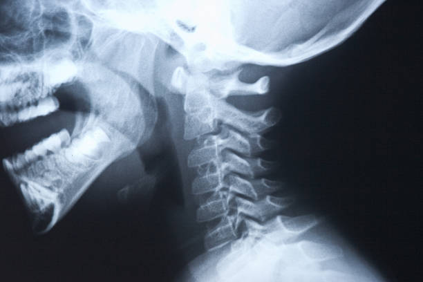 istock Head X-Ray Neck detail 174647034