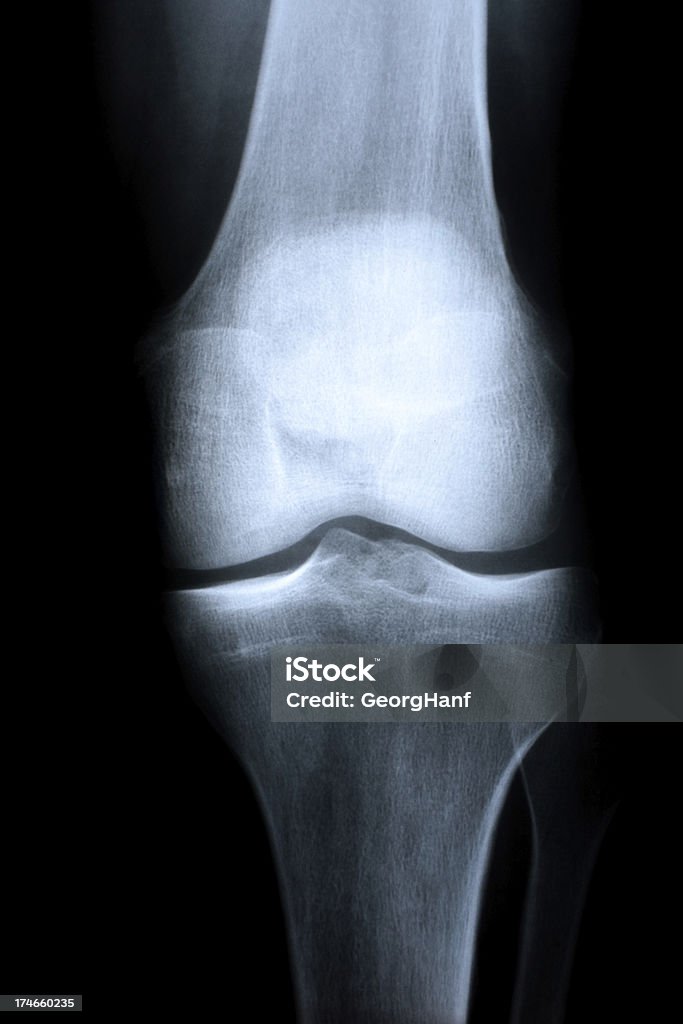 Die Knie gemeinsamen - Lizenzfrei Anatomie Stock-Foto