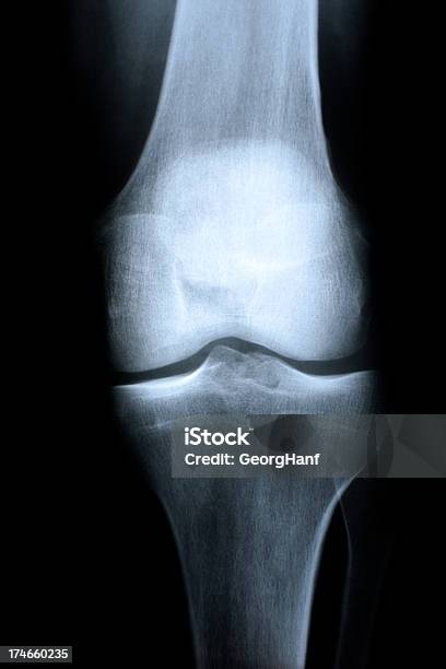 Die Knie Gemeinsamen Stockfoto und mehr Bilder von Anatomie - Anatomie, Beinknochen, Bildtechnik