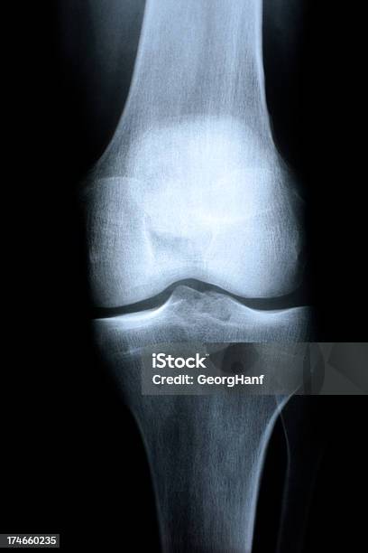 La Articulación De La Rodilla Foto de stock y más banco de imágenes de Afección médica - Afección médica, Anatomía, Articulación