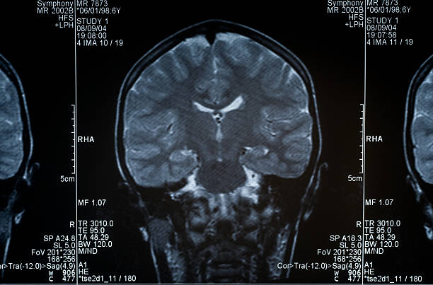 cerveau montrant scanner à résonance magnétique plusieurs images de la tête et du crâne - corpus striatum photos et images de collection