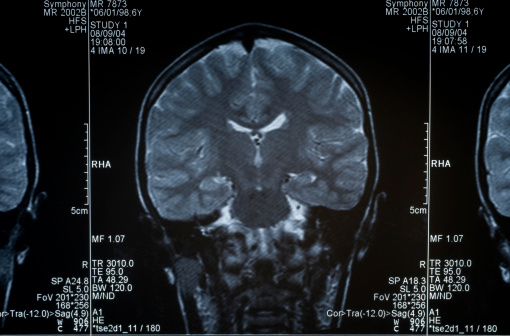 MRI scan of the human brain (Anonymous )