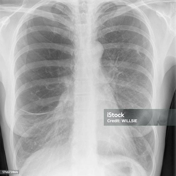デジタル胸 X 線のヘビー式燻製器肺気腫 - X線撮影のストックフォトや画像を多数ご用意 - X線撮影, スクエア, テクノロジー