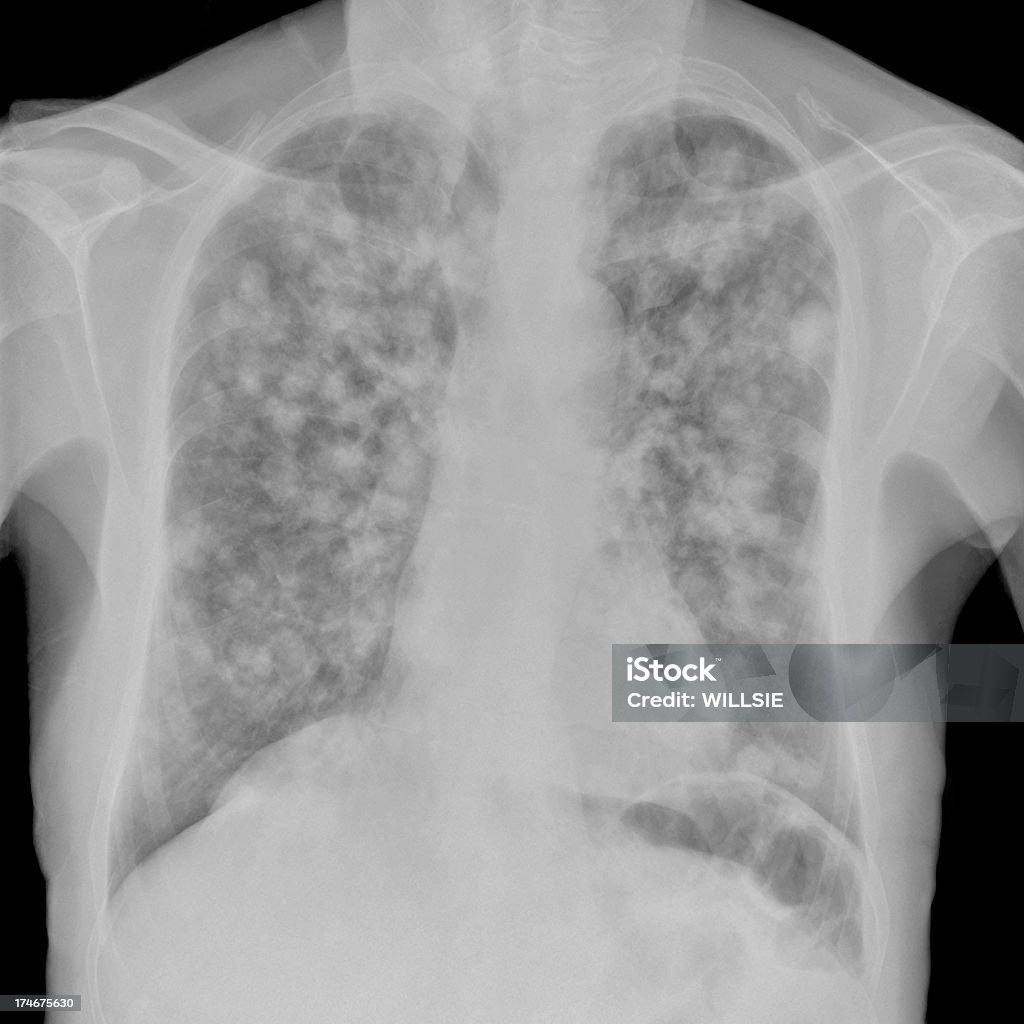 Digital chest x-ray  of multiple pulmonary metastases in widespread cancer Black and white image of a digital chest x-ray showing pulmonary metastases throughout both lungs as evidenced by the many white rounded opacities of different sizes. Detection of these is essential for cancer management. Commonly encountered in cancer spread from breast, thyroid, kidney, colon and lung. Metastasis Stock Photo