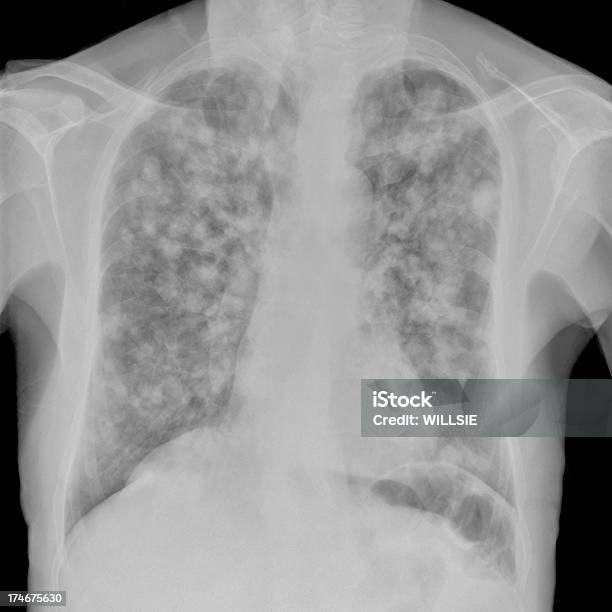 Digital Chest Xray Of Multiple Pulmonary Metastases In Widespread Cancer Stock Photo - Download Image Now