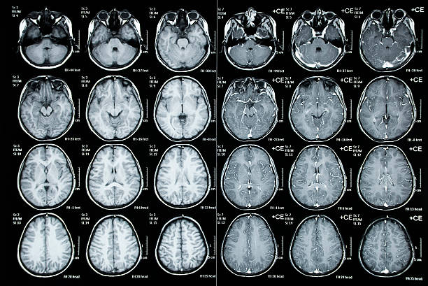 Normal Cat Scan image of a child cranium
