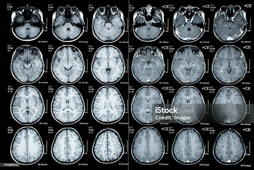 Cranial Tomography Image Of  Child Patient Normal Cat Scan image of a child cranium CAT Scan Stock Photo