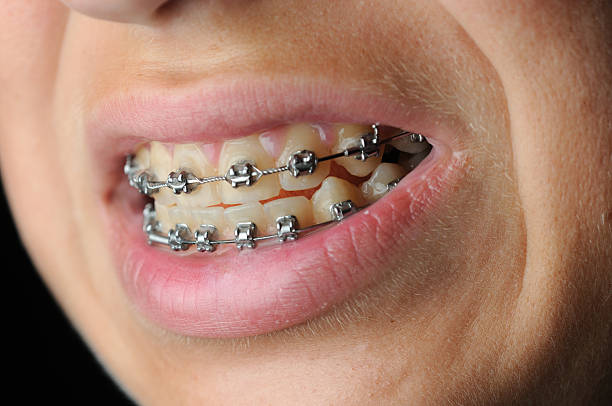 istock Close up of braces 174696326