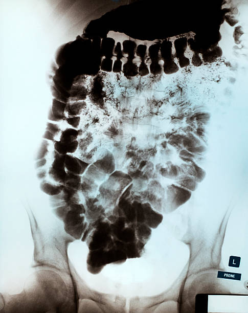 istock X-ray Of A Human Stomach And Intestines 174697117