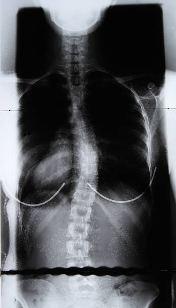 istock X-ray of a female spine 174702433