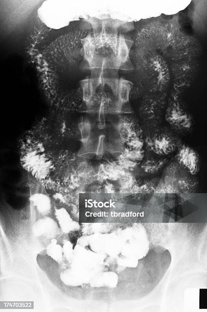 Xray Of Menschlichen Bauch Und Intestines Stockfoto und mehr Bilder von Bauch - Bauch, Daten, Diagnosehilfe