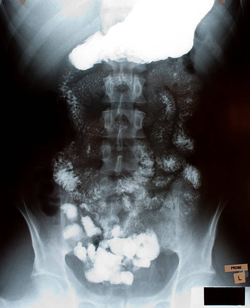 istock X-ray Of A Human Stomach And Small Intestines 174704047