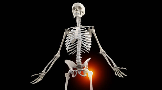 istock X-ray view of human skeleton with hip pain 1747187851