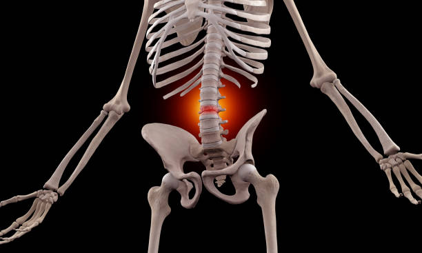 istock Human skeleton with stenosis of the spine 1747188893