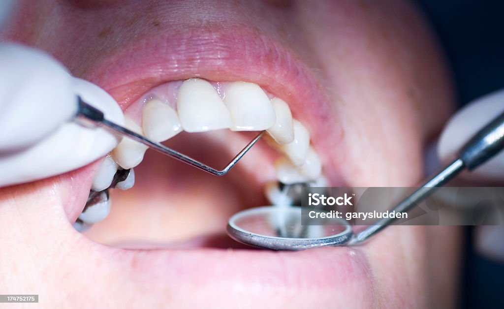 歯科検査 - 歯科充てん材のロイヤリティフリーストックフォト