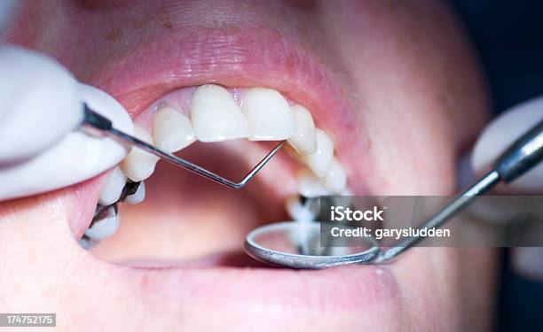 歯科検査 - 歯科充てん材のストックフォトや画像を多数ご用意 - 歯科充てん材, 合金, 歯科衛生