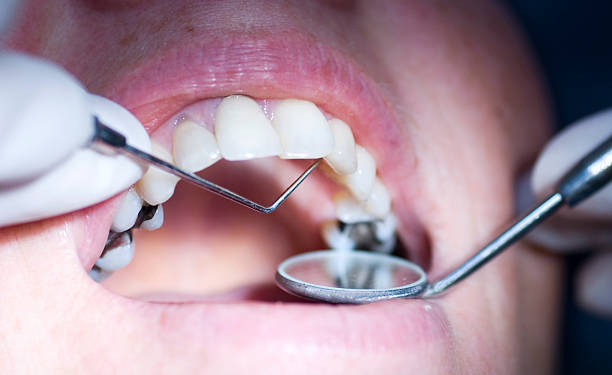 Close-up of mouth getting dental exam "patient having a dental examination  up, close up with narrow depth of field focus on probe" dental cavity photos stock pictures, royalty-free photos & images