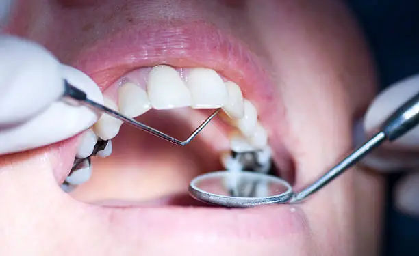 "patient having a dental examination  up, close up with narrow depth of field focus on probe"