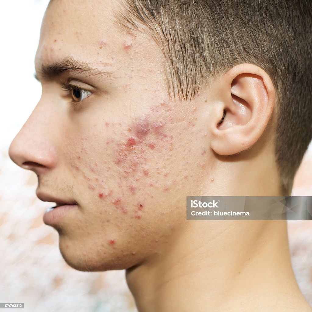 Acne Puberty age and pimples. Male with acne Acne Stock Photo