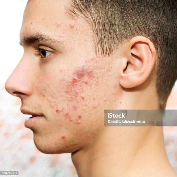 Acne Stock Photo - Download Image Now - Acne, Men, Pimple