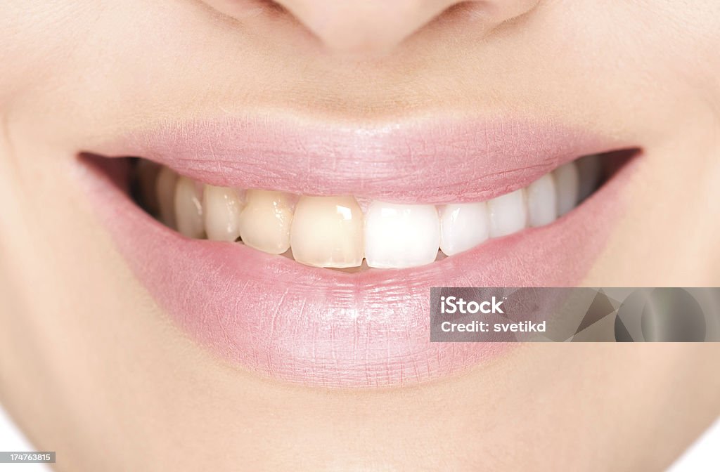 Antes y después del blanqueamiento dental. - Foto de stock de Blanqueamiento dental libre de derechos
