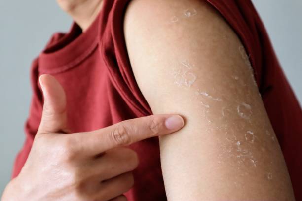 istock Person pointing at tanned skin 1747701319