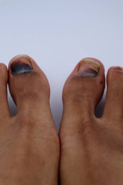 istock Person with injured nails on both feet 1747715176