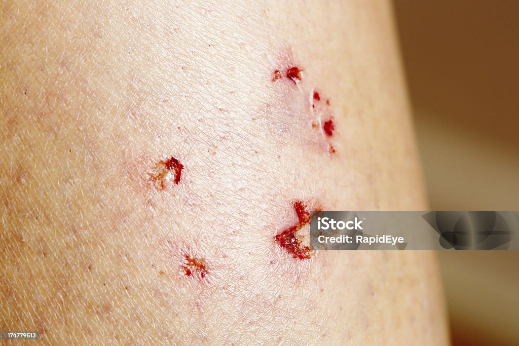 Dog bite! Toothmarks in leg after nasty canine attack A woman's leg shows clear puncture marks and bruising from a vicious dog bite. Missing Bite Stock Photo