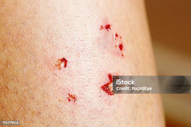 Dog Bite Toothmarks In Leg After Nasty Canine Attack Stock Photo - Download Image Now