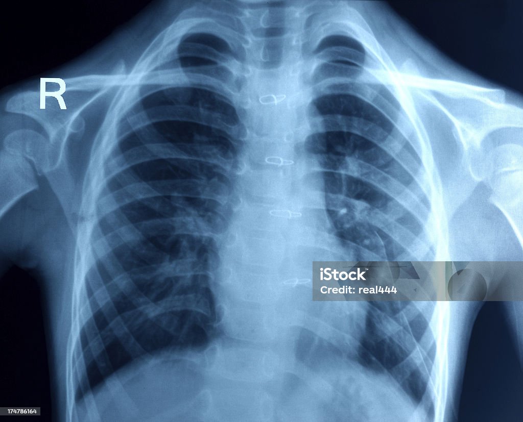 Röntgenbild der Brust - Lizenzfrei Anatomie Stock-Foto