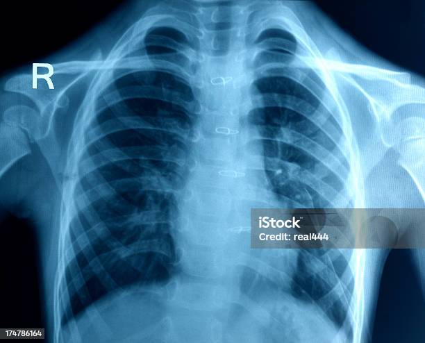 Röntgenbild Der Brust Stockfoto und mehr Bilder von Anatomie - Anatomie, Beleuchtet, Bildkomposition und Technik