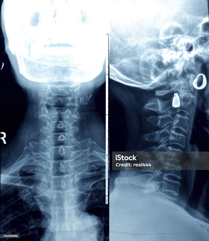 人間の頚椎 xray - X線撮影のロイヤリティフリーストックフォト