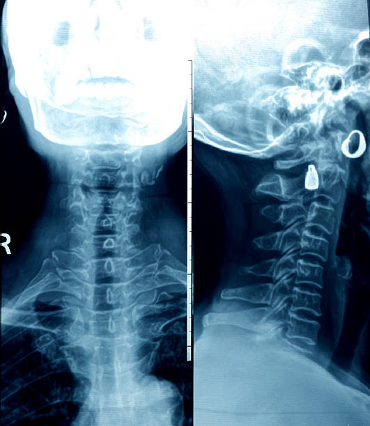 xray humano coluna cervical - skullpan imagens e fotografias de stock