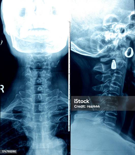 Foto de Homem Xray Da Coluna Cervical e mais fotos de stock de Adulto - Adulto, Anatomia, Articulação Humana - Termo anatômico