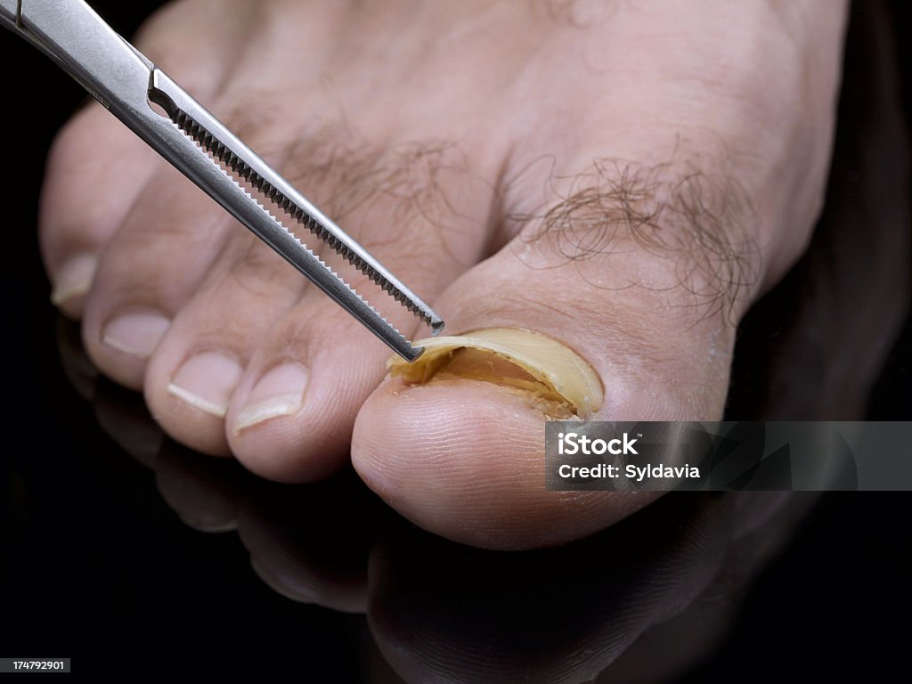 Zehennagel Pilz - Lizenzfrei Nagelpilz Stock-Foto