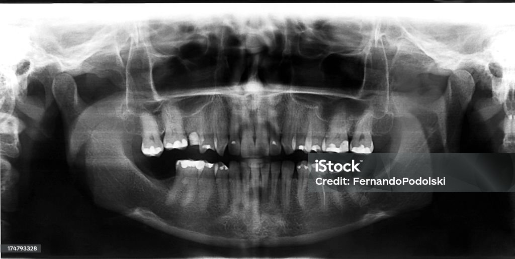 X-ray Panoramic radiography of the dental arch of a woman 30 years Data Stock Photo