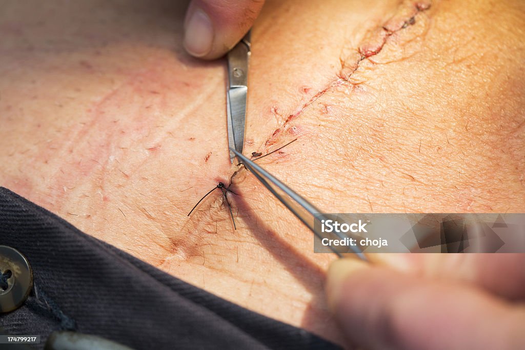 Nurse at work...removing stitches from a wound Nurse at work...removing stitches from a wound after abdominal operationShallow dof A Helping Hand Stock Photo